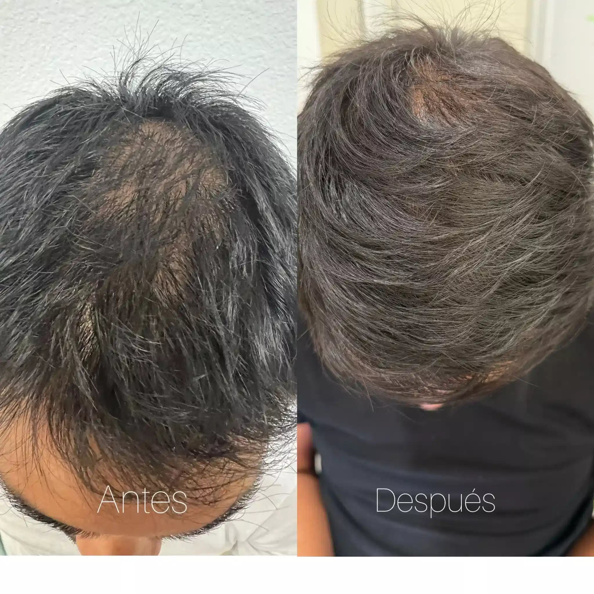 Before and after Microneedling with exosomes for hair redensification