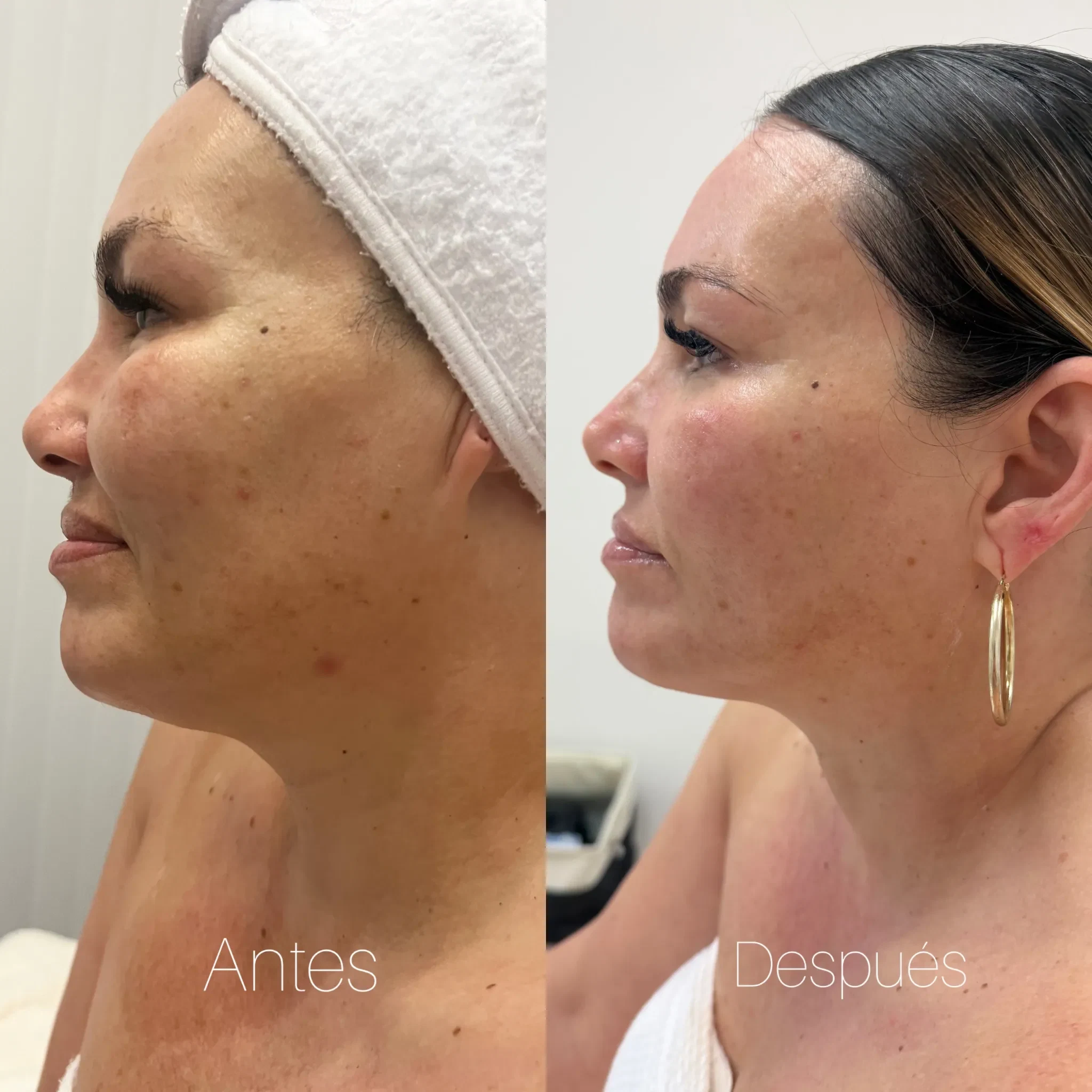 Before and after Morpheus8 for texture and skin firmness