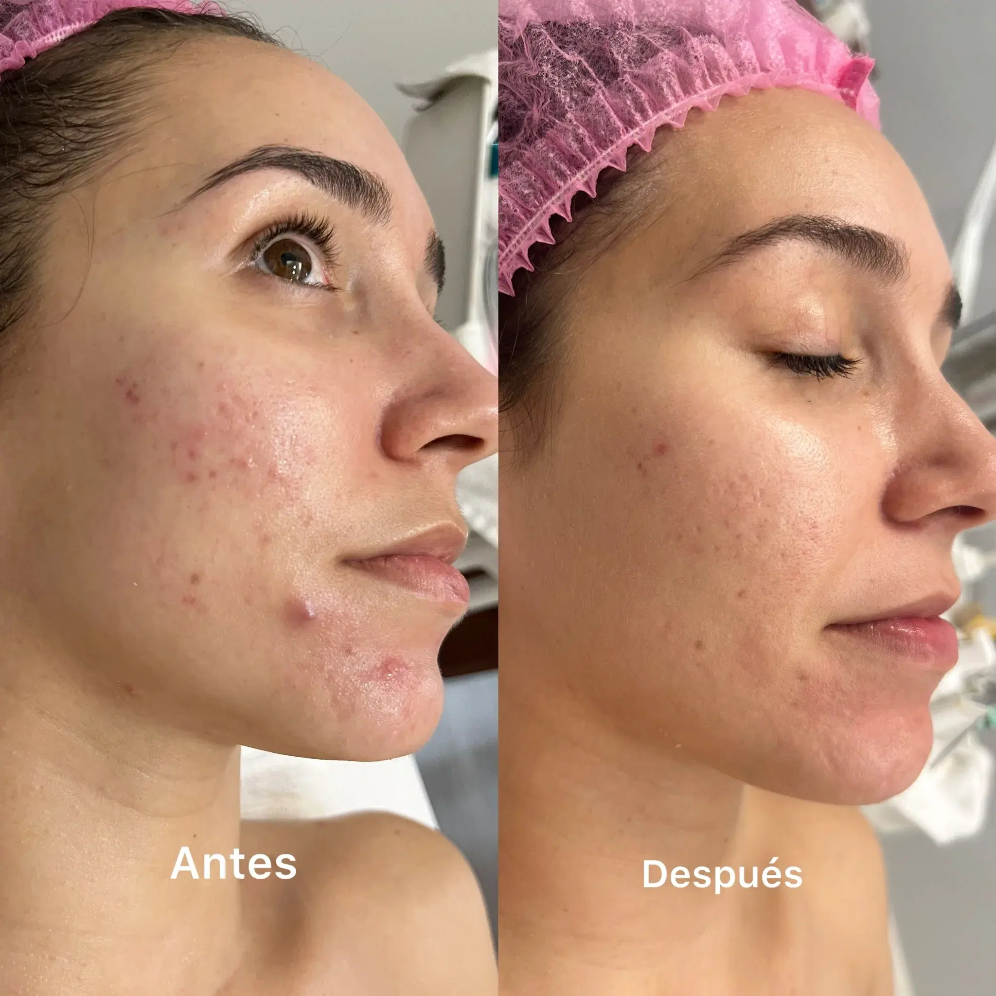 Before and after IPL with chemical peels for acne