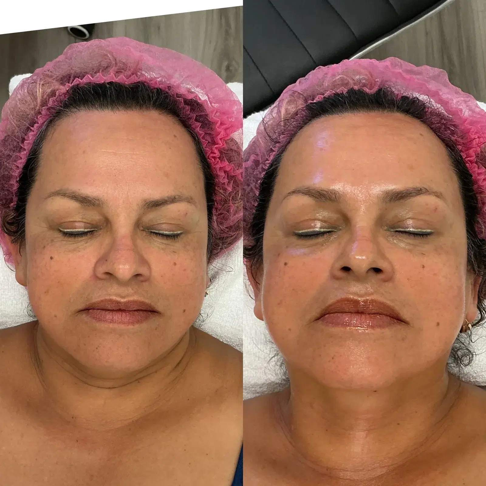 Before and after Microneedling for texture and hydration