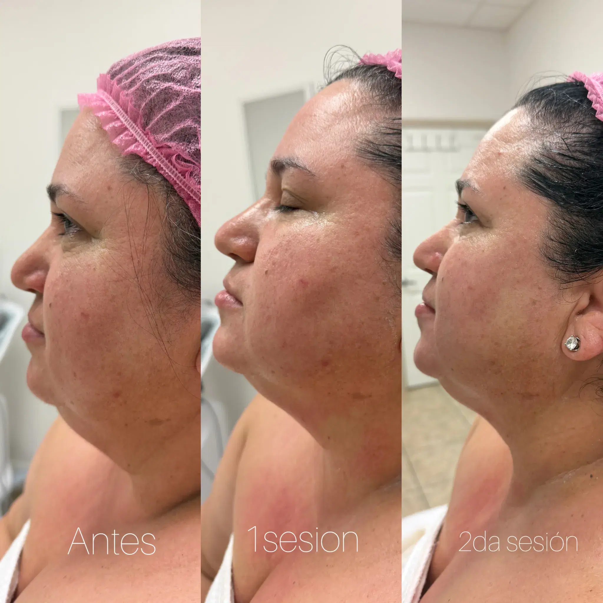 Before and after Morpheus8 for skin laxity