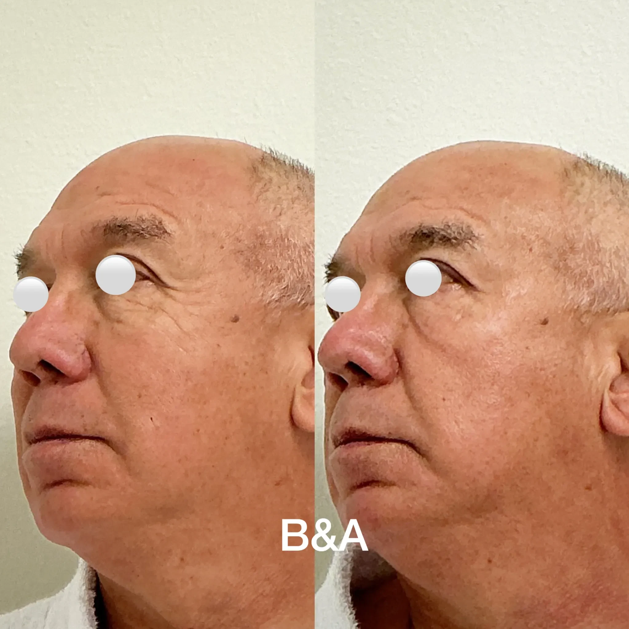 Before and after Morpheus8 for wrinkles