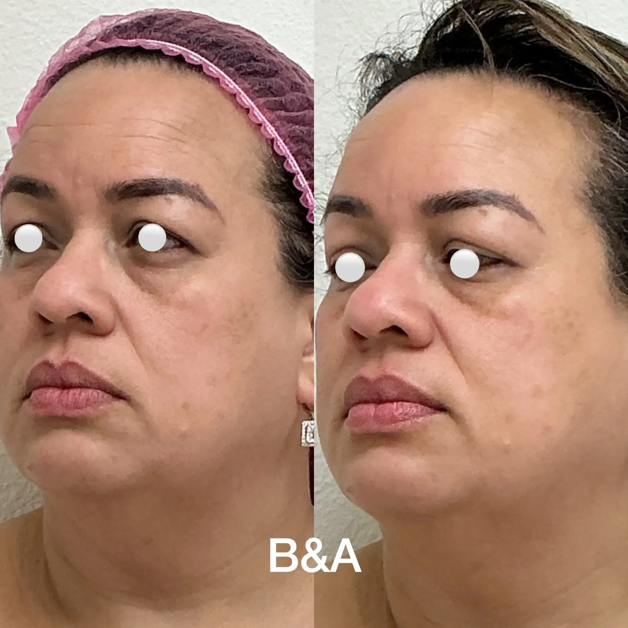 Before and after Microneedling for wrinkles