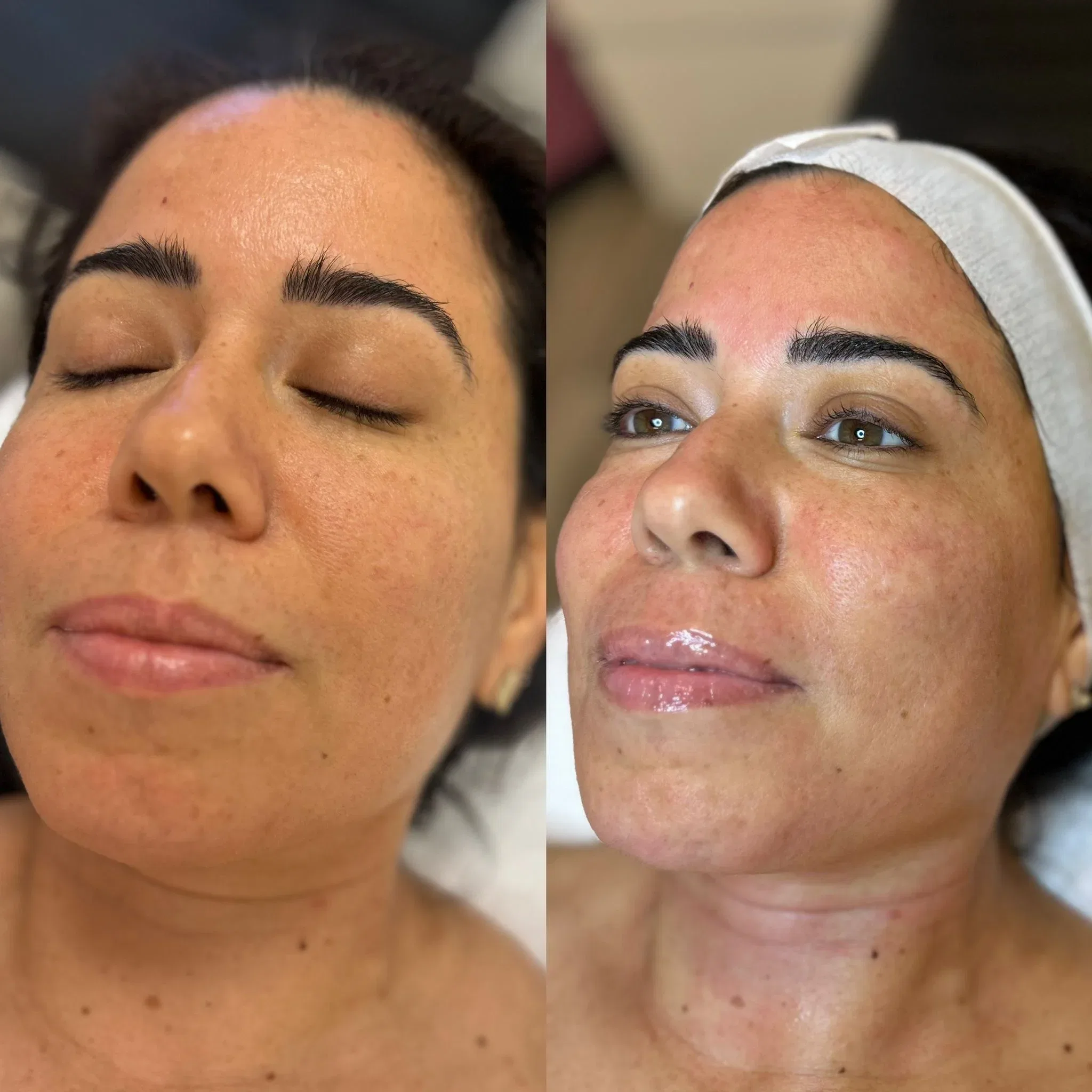Before and after Microneedling for texture and hydration