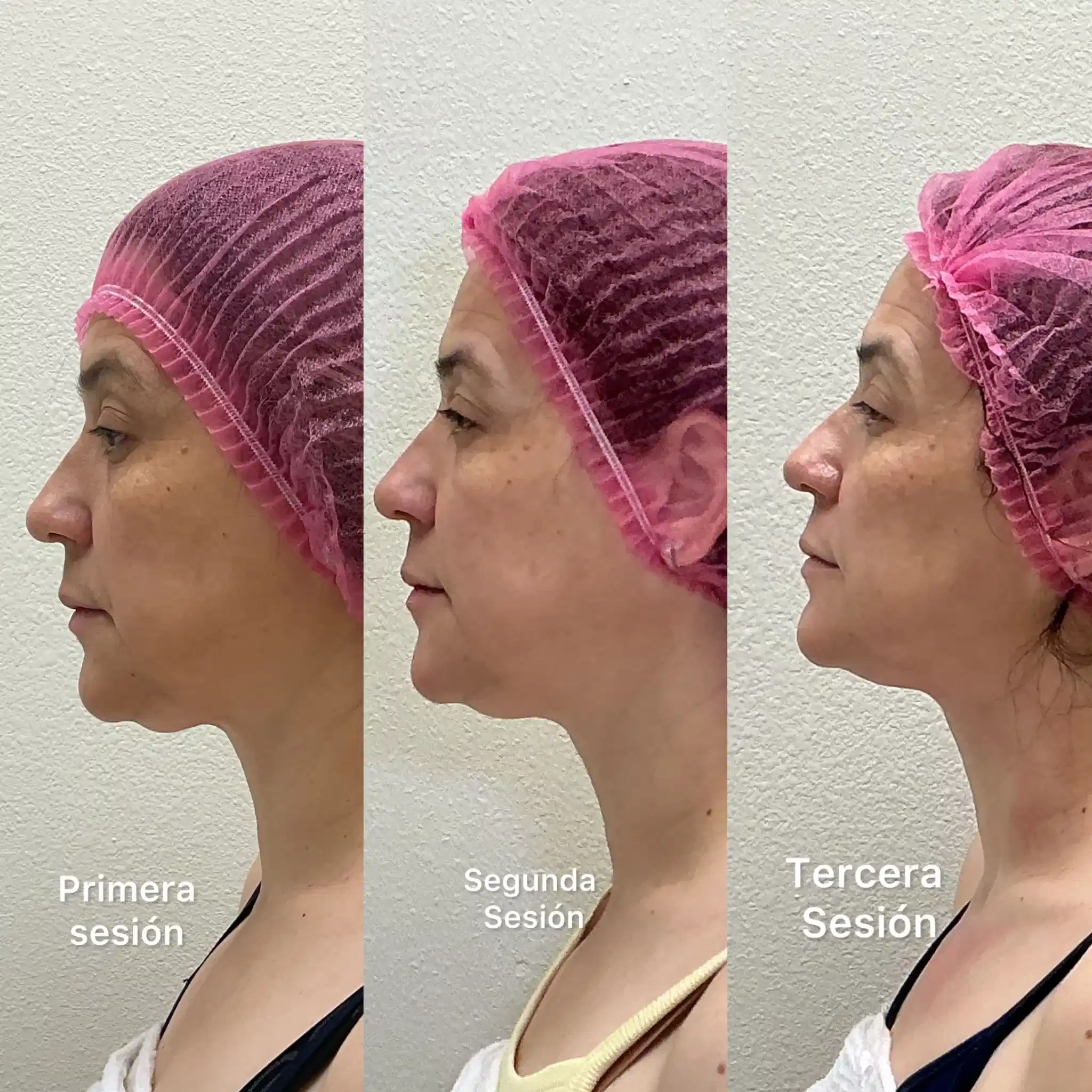 Before and after Morpheus8 for skin laxity case study