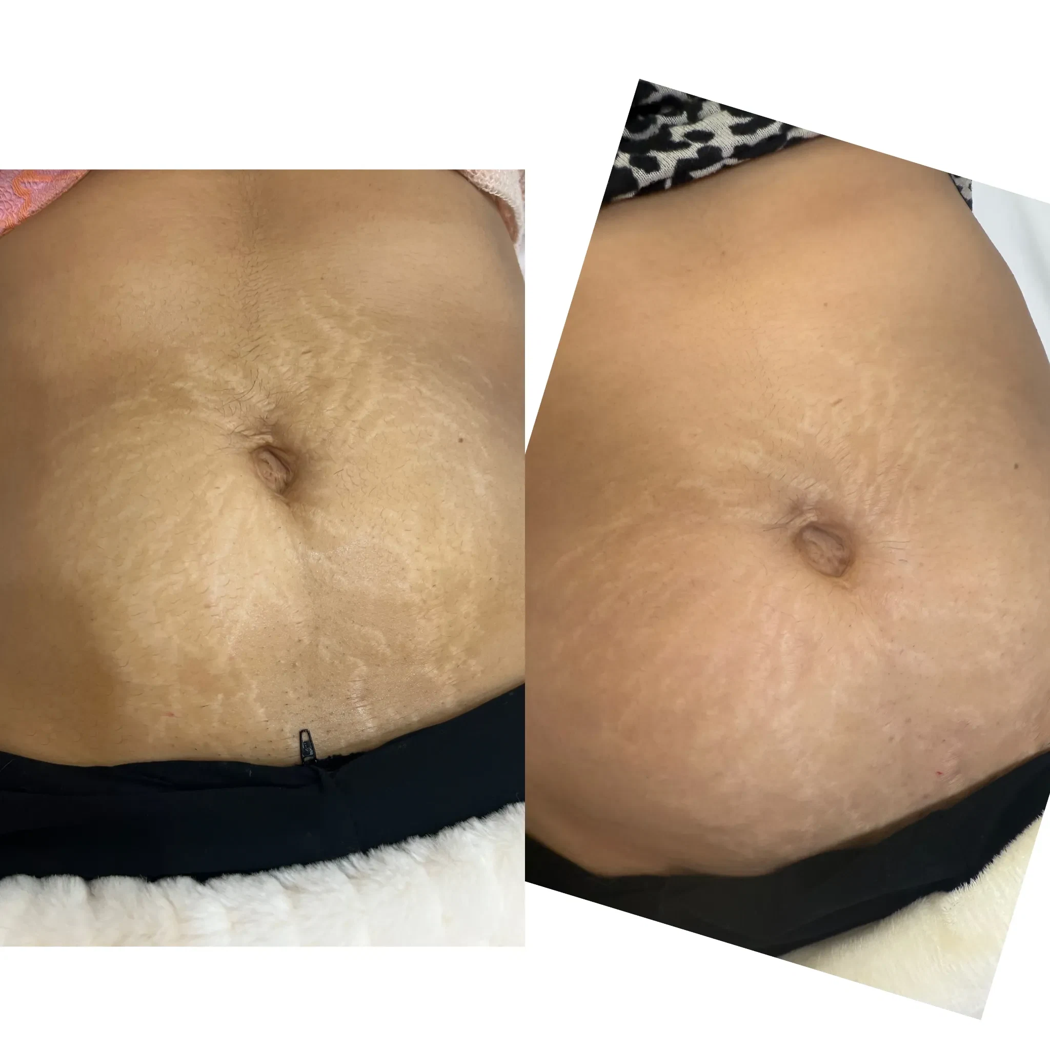 Before and after Morpheus8 Body for stretch marks