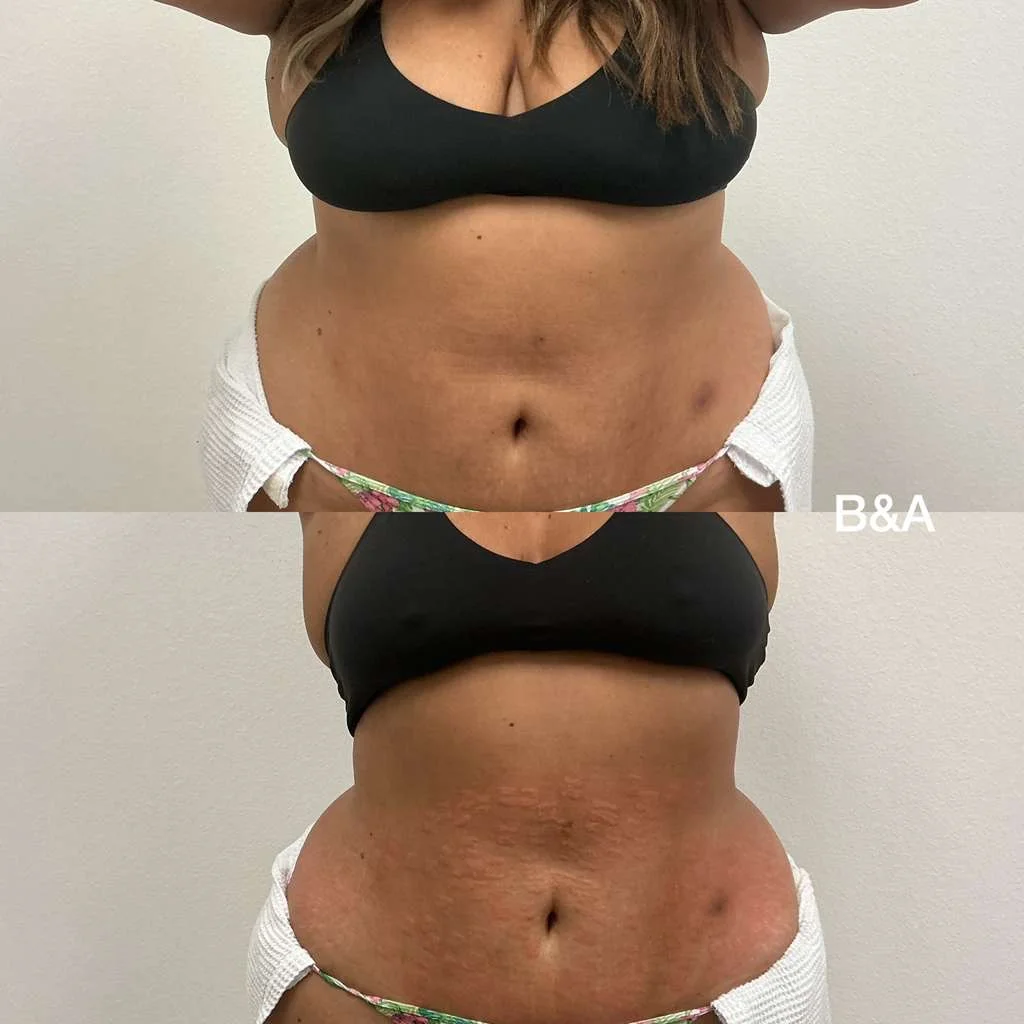 Before and after Morpheus8 Body for contouring