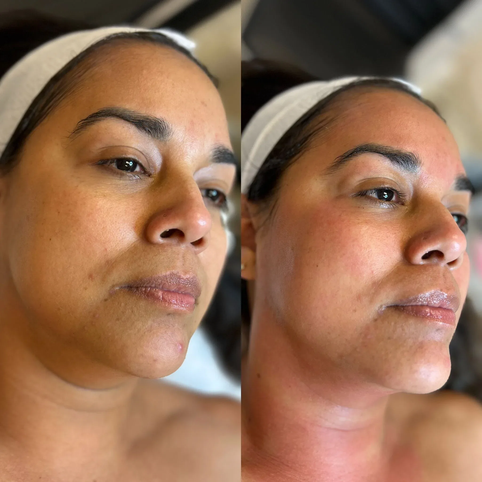 Before and after Morpheus8 for skin laxity
