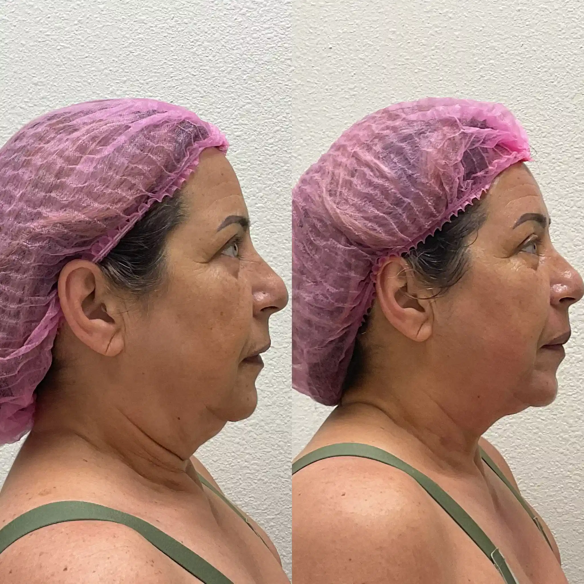 Before and after Morpheus8 for skin laxity