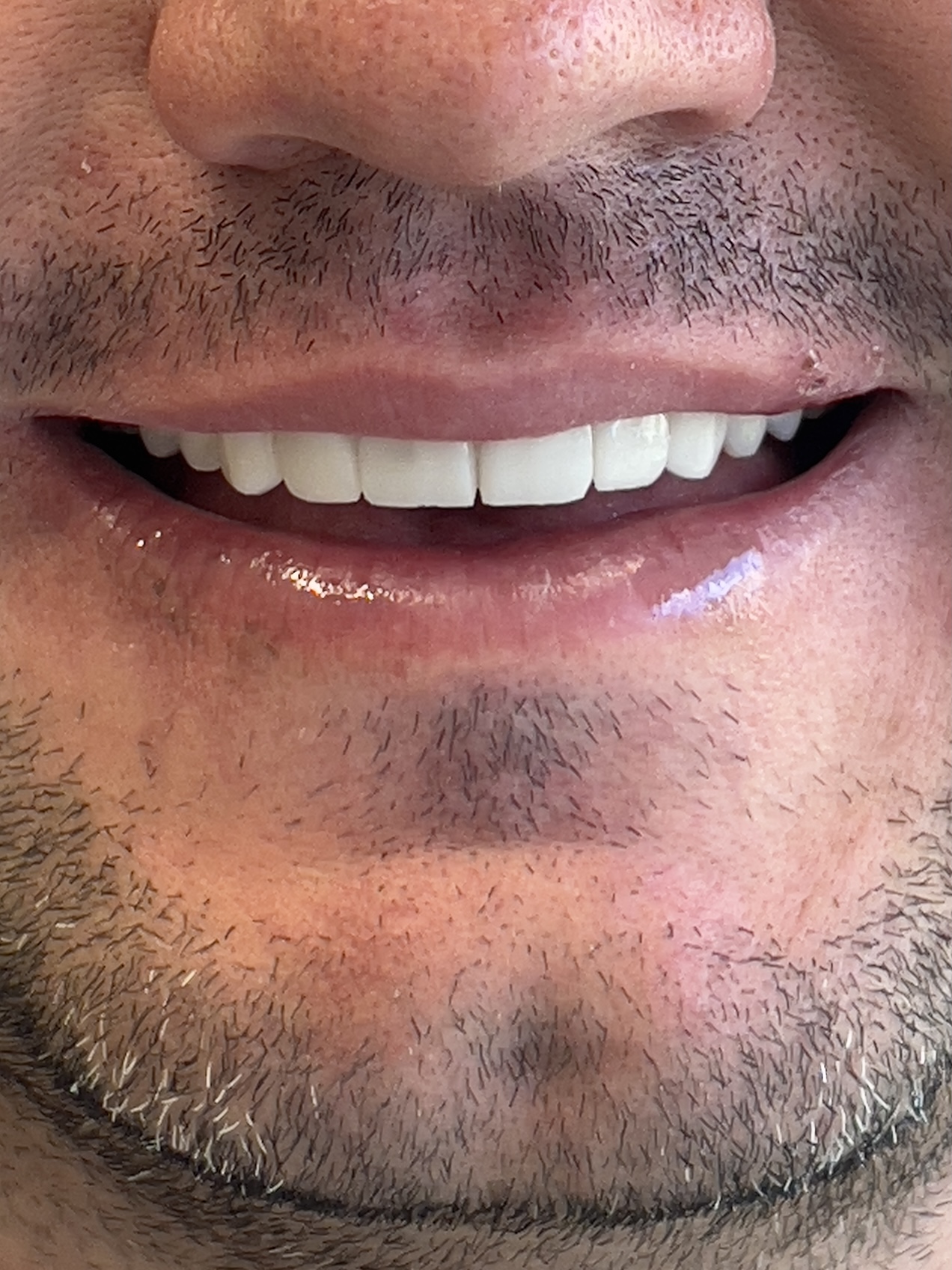 Trabajo realizado · Diseño de sonrisa