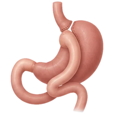 Ilustración del bypass gástrico: un estómago pequeño unido a una parte del intestino delgado