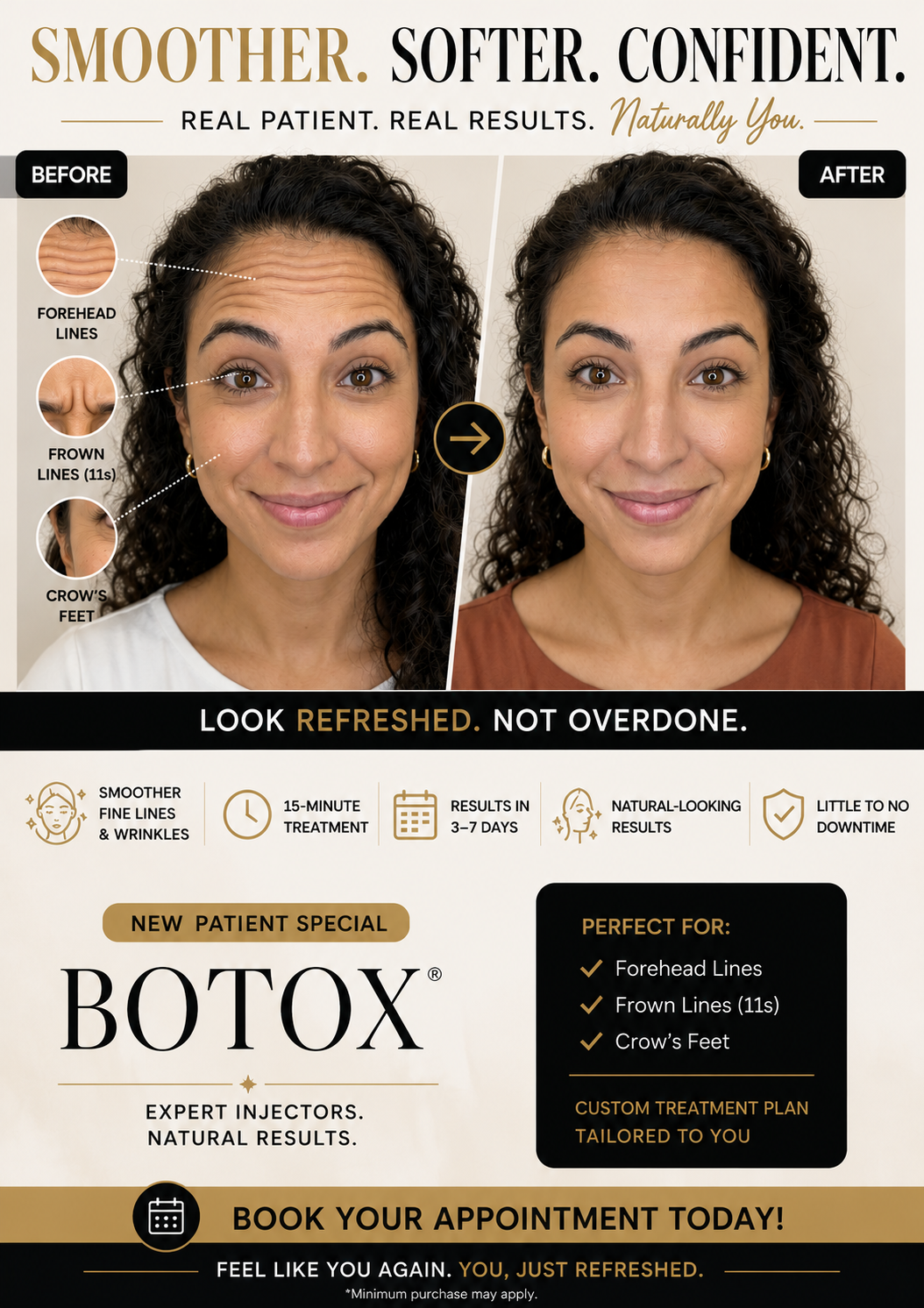 MDW patient before Botox: forehead lines, frown lines and crow's feet