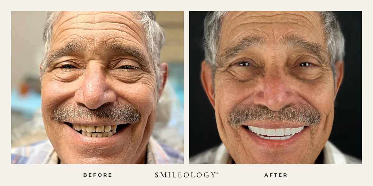 Smileology&reg; patient before and after treatment, case BA 02