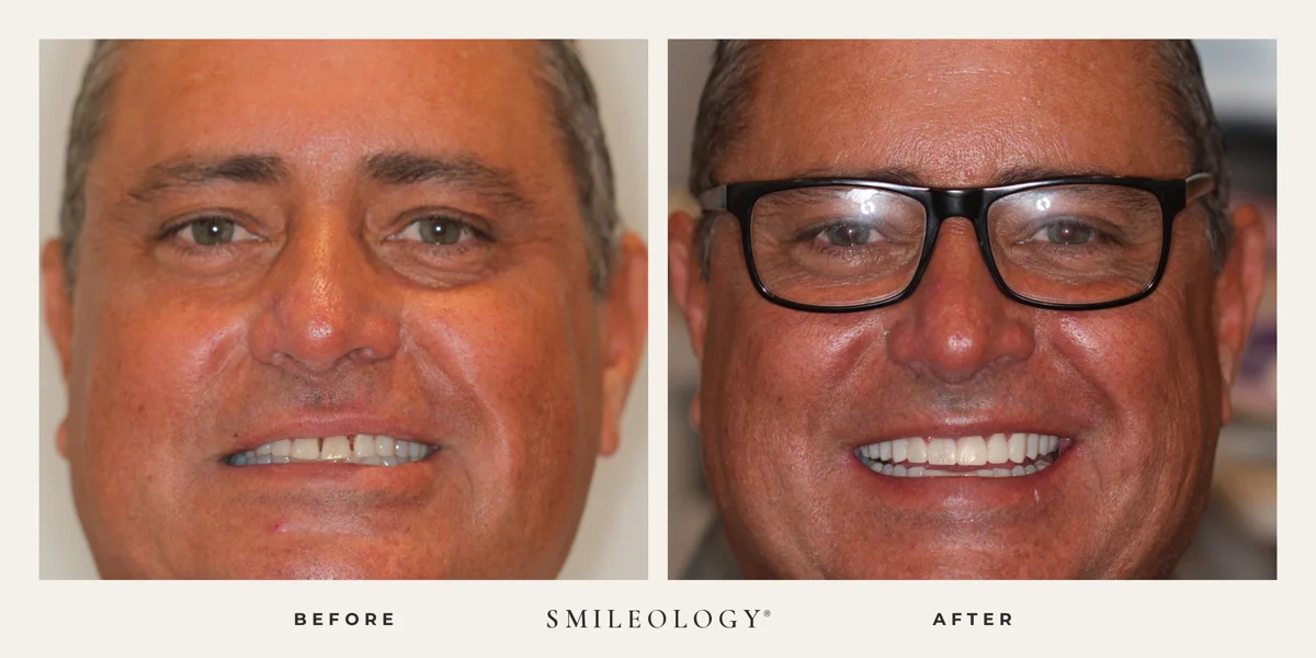 Smileology&reg; patient before and after treatment, case BA 03
