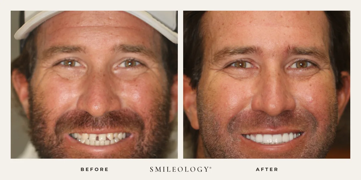 Smileology&reg; patient before and after treatment, case BA 06