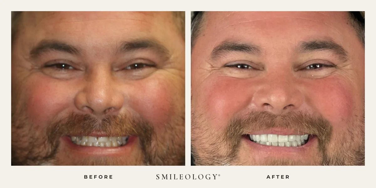 Smileology&reg; patient before and after treatment, case BA 01