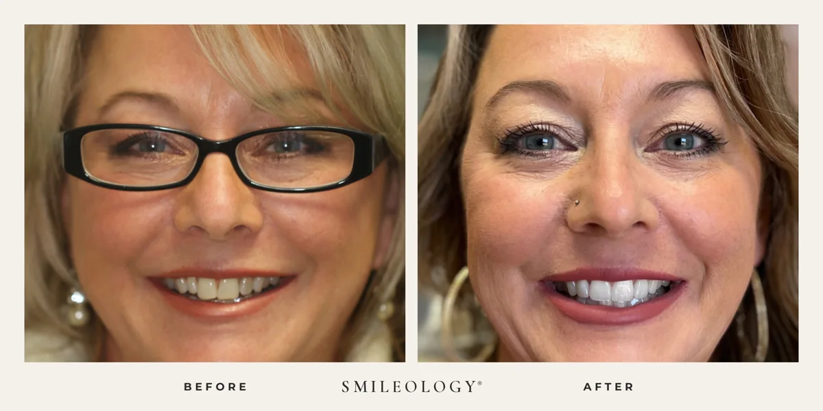 Smileology&reg; patient before and after treatment, case BA 04