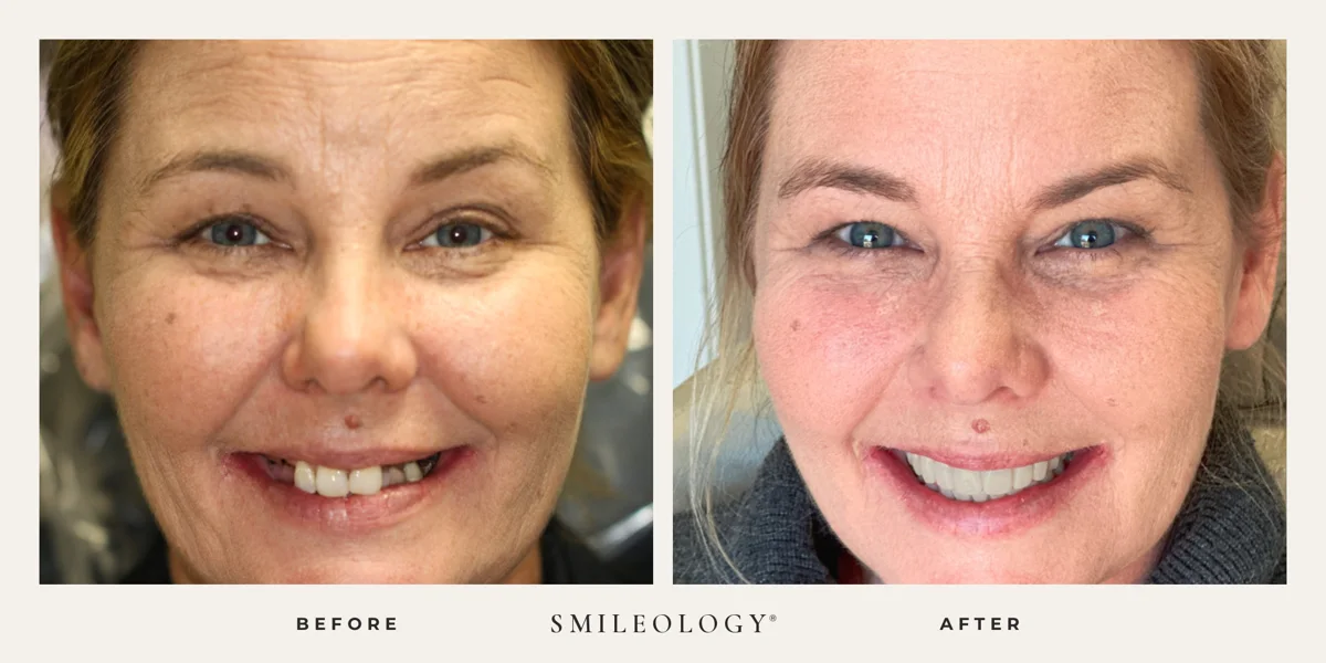 Smileology&reg; patient before and after treatment, case BA 05
