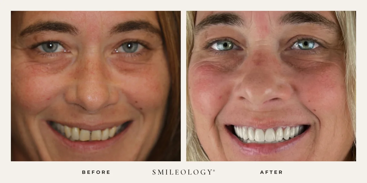 Smileology&reg; patient before and after treatment, case BA 08