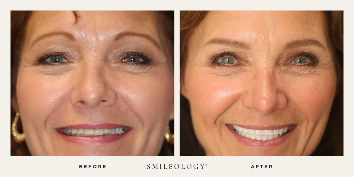 Smileology&reg; patient before and after treatment, case BA 10