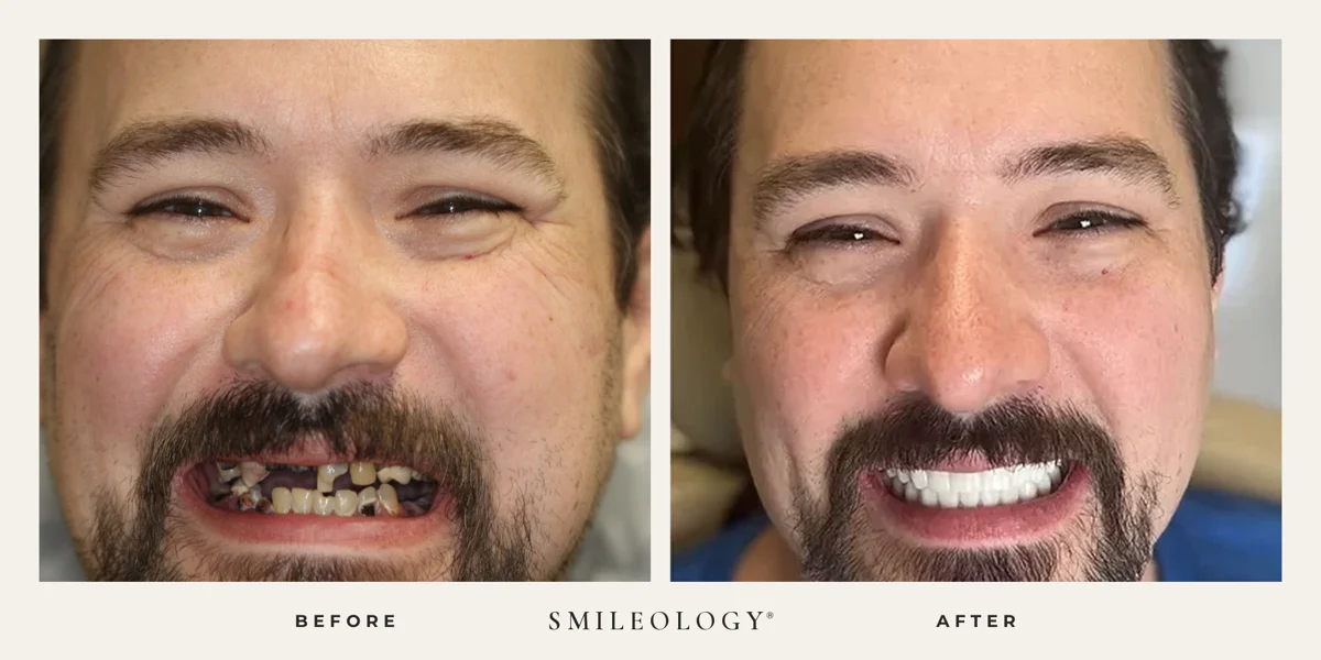 Smileology&reg; patient before and after treatment, case BA 09