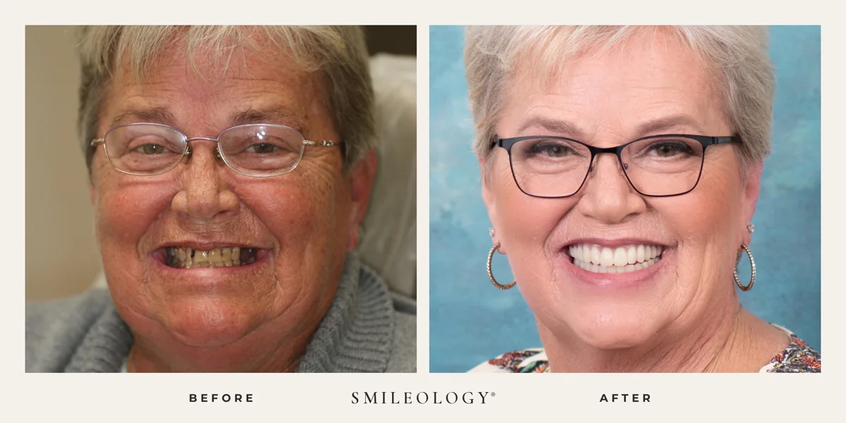 Smileology&reg; patient before and after treatment, case BA 07