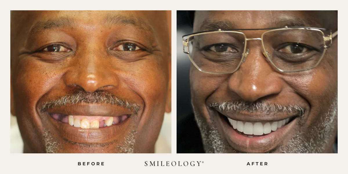 Smileology&reg; patient before and after treatment, case BA 11