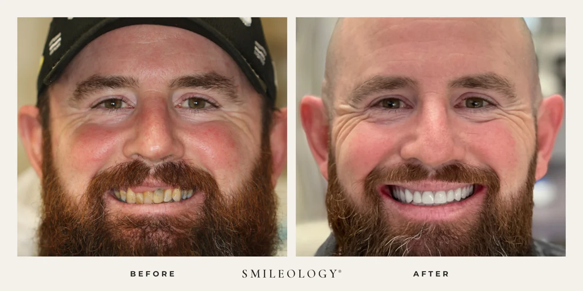 Smileology&reg; patient before and after treatment, case BA 12