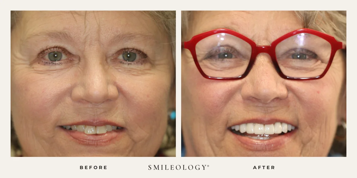 Smileology&reg; patient before and after treatment, case BA 14
