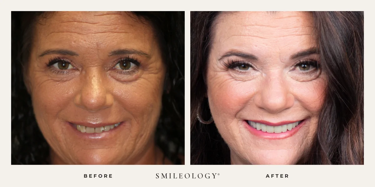 Smileology&reg; patient before and after treatment, case BA 13