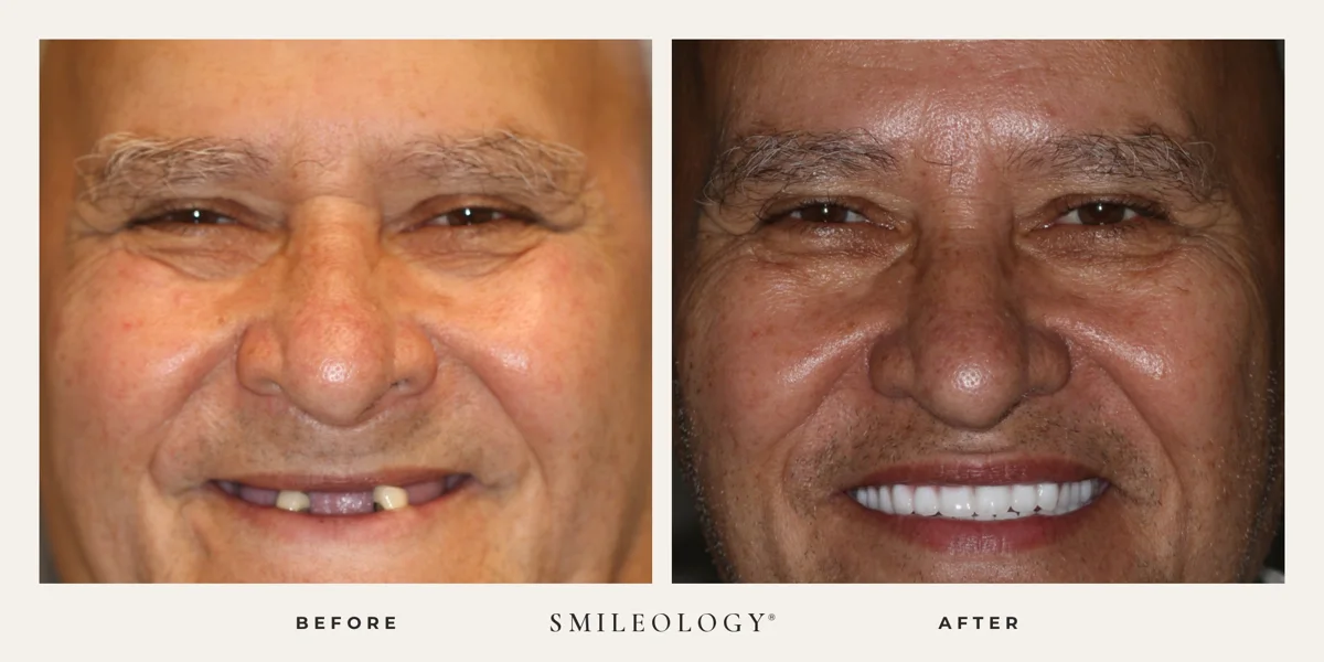 Smileology&reg; patient before and after treatment, case BA 15