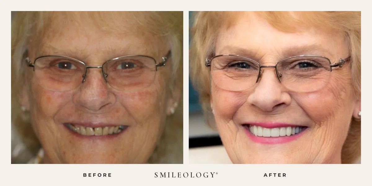 Smileology&reg; patient before and after treatment, case BA 19