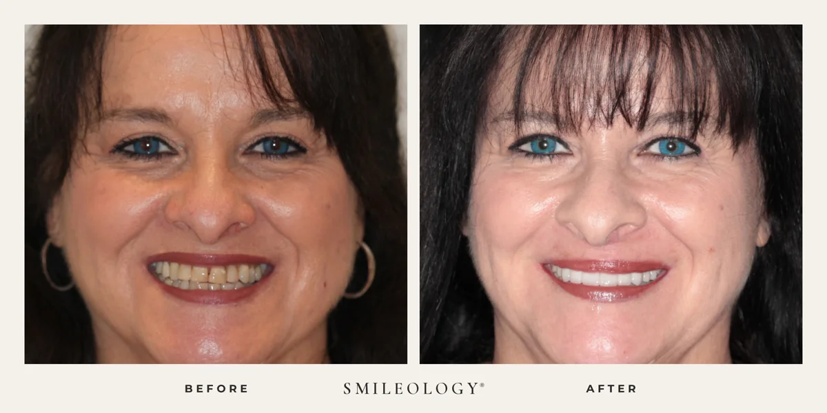 Smileology&reg; patient before and after treatment, case BA 17