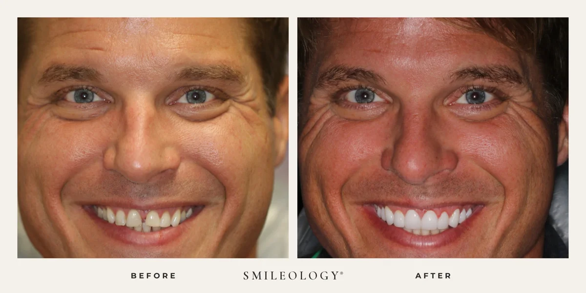 Smileology&reg; patient before and after treatment, case BA 18