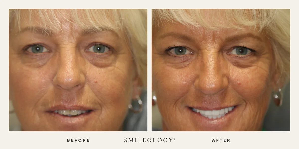 Smileology&reg; patient before and after treatment, case BA 16