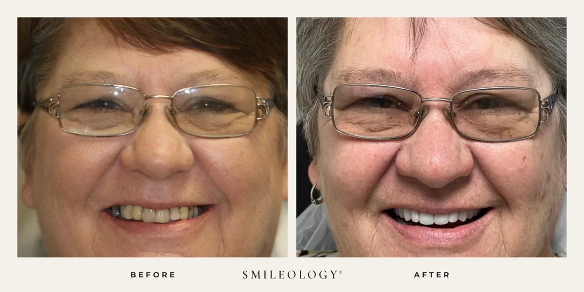 Smileology&reg; patient before and after treatment, case BA 20