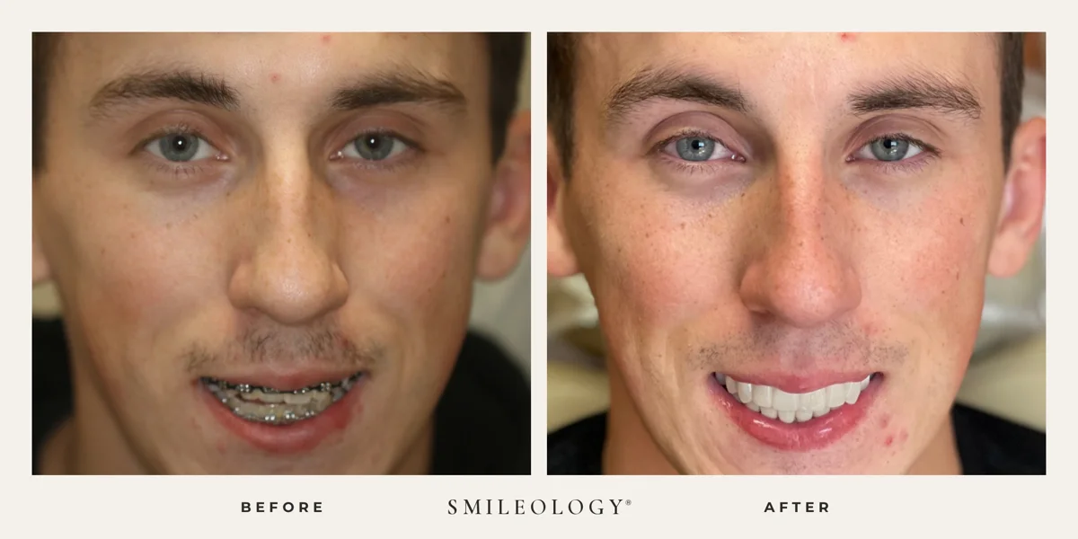 Smileology&reg; patient before and after treatment, case BA 23