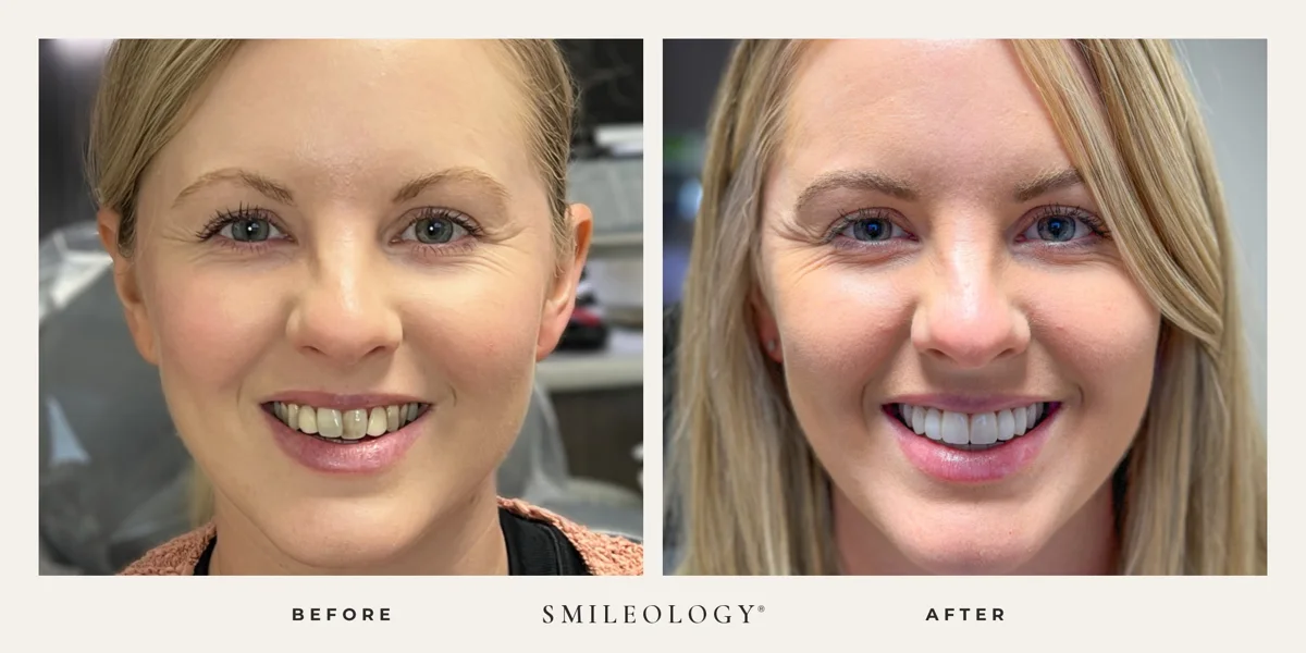 Smileology&reg; patient before and after treatment, case BA 24