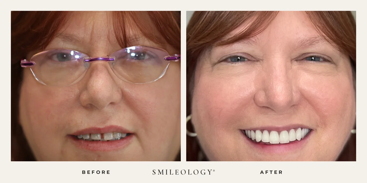 Smileology&reg; patient before and after treatment, case BA 22