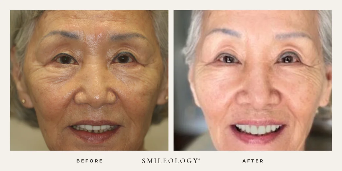 Smileology&reg; patient before and after treatment, case BA 21