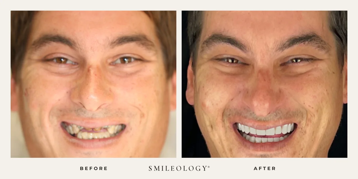 Smileology&reg; patient before and after treatment, case BA 29