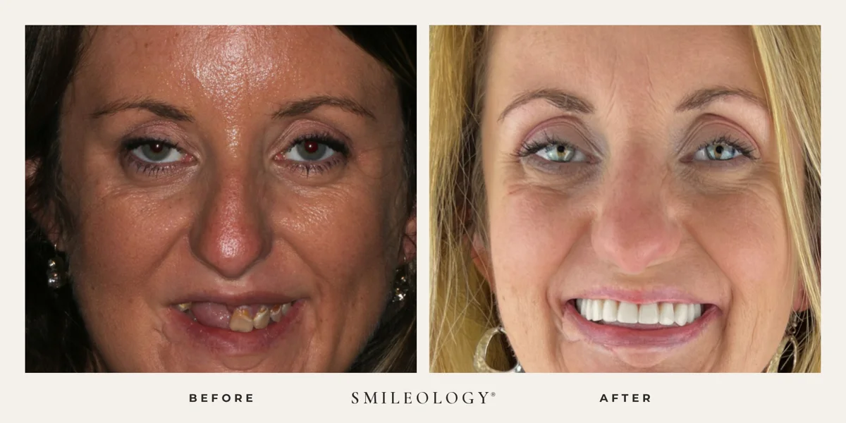 Smileology&reg; patient before and after treatment, case BA 28