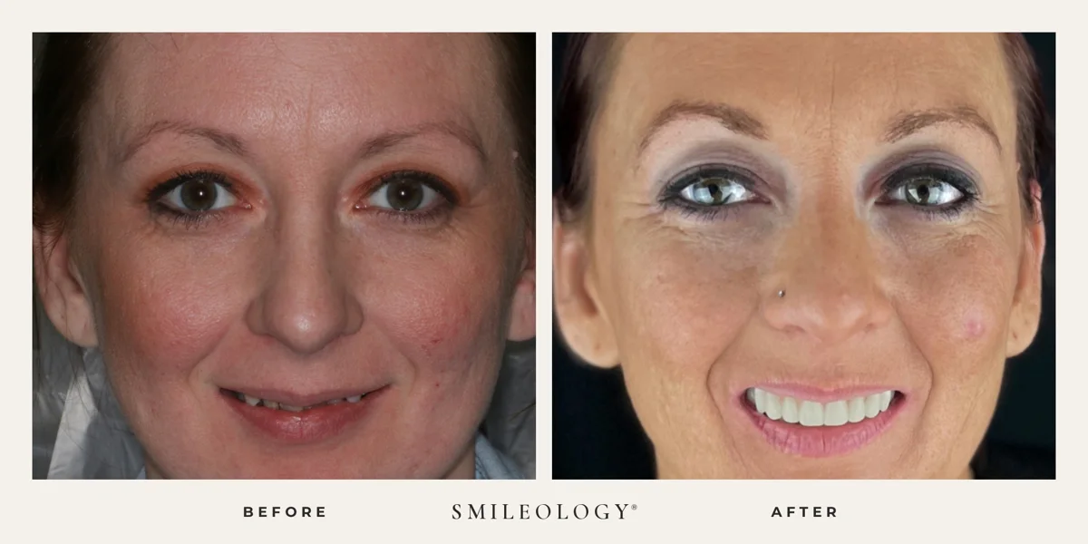 Smileology&reg; patient before and after treatment, case BA 27b