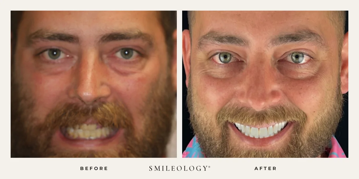 Smileology&reg; patient before and after treatment, case BA 30