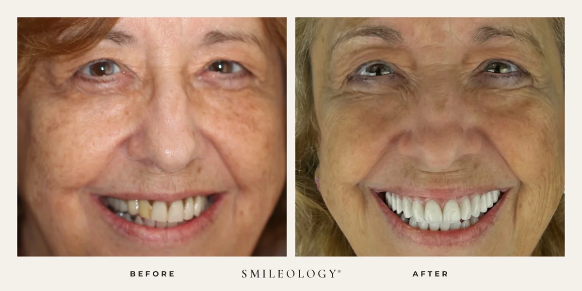 Smileology&reg; patient before and after treatment, case BA 25