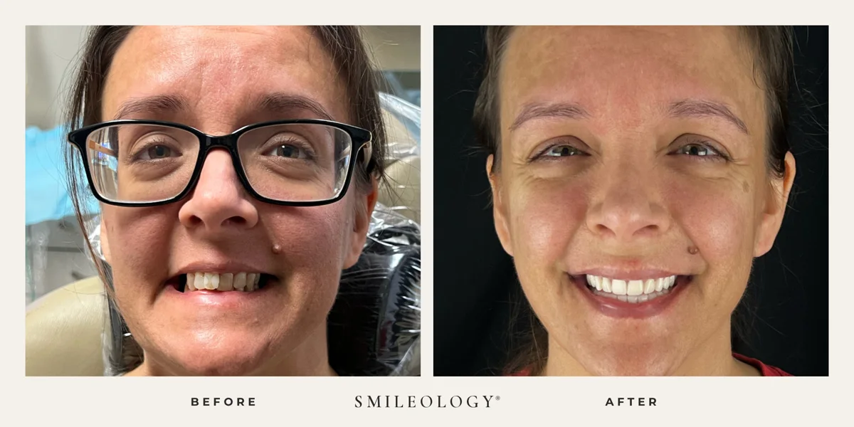 Smileology&reg; patient before and after treatment, case BA 26