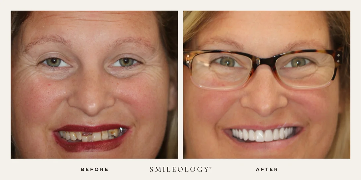 Smileology&reg; patient before and after treatment, case BA 34