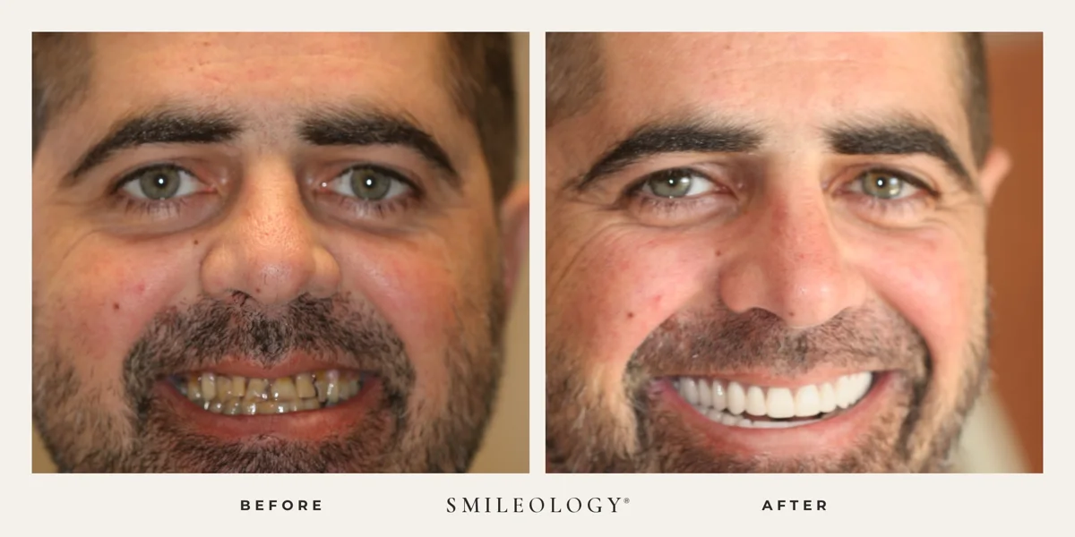 Smileology&reg; patient before and after treatment, case BA 31