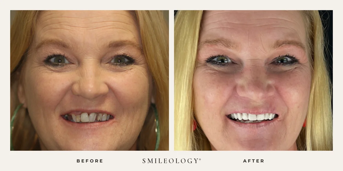 Smileology&reg; patient before and after treatment, case BA 32