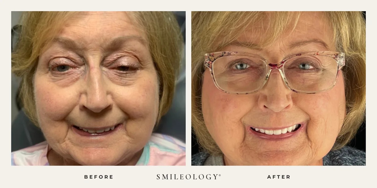 Smileology&reg; patient before and after treatment, case BA 33